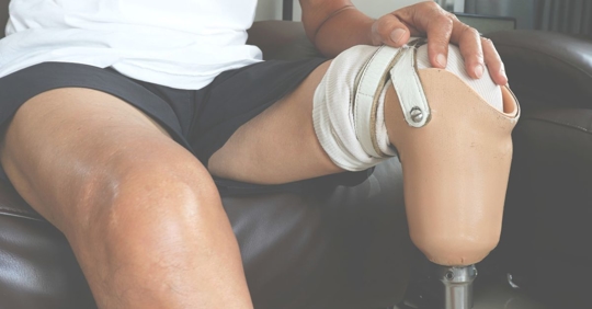 a leg amputee in a prosthetic