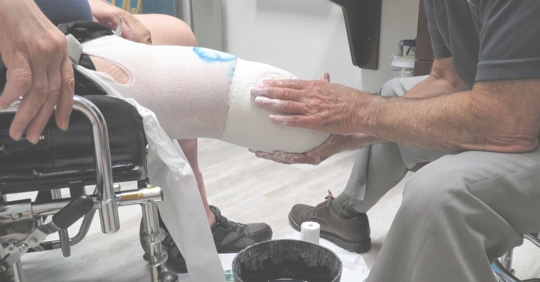 amputee being fitted with a mold